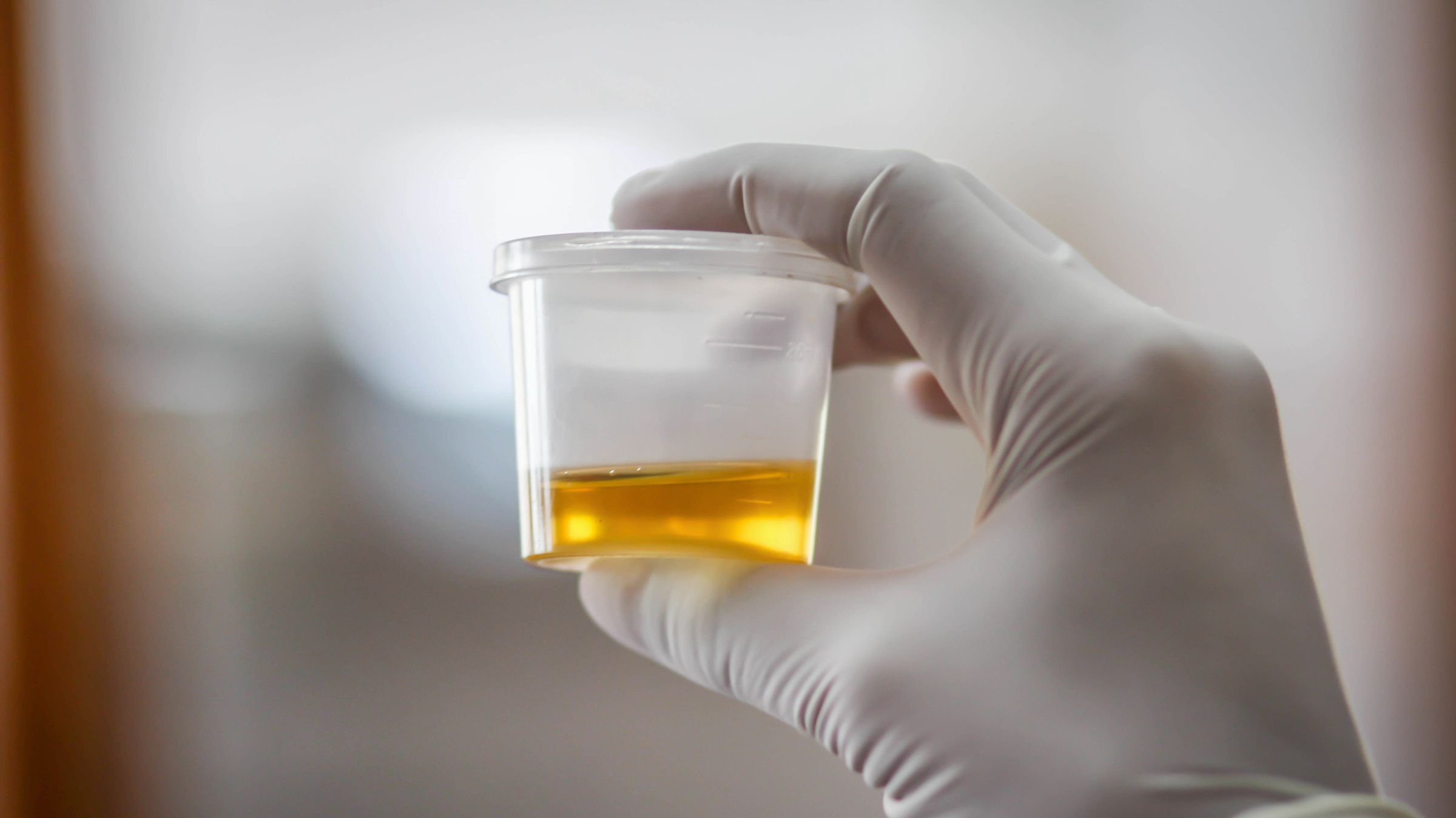 How To Pass an Alcohol Urine Test for Probation