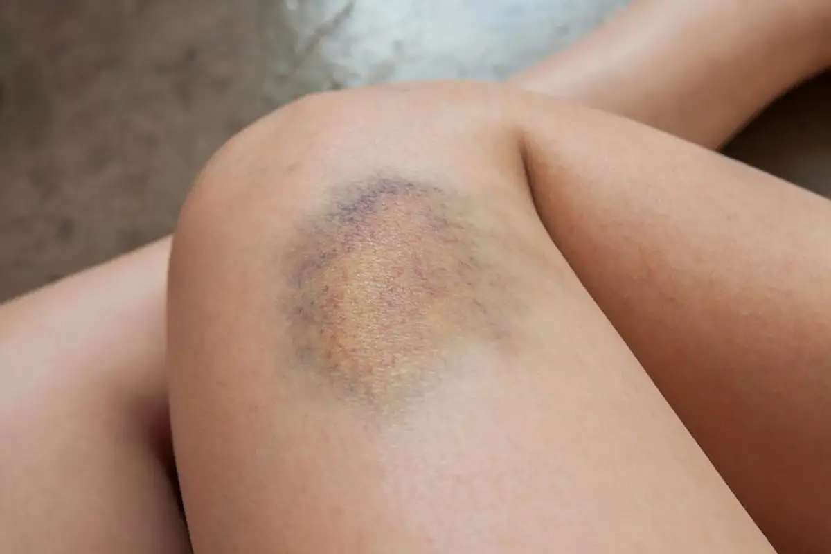 Bruises From Alcohol